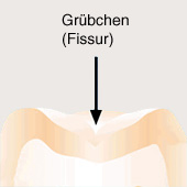 Jeder Backenzahn (Molar und Pr�molar) hat
                          jeweils ein Gr�bchen (Fissur), die so genannte
                          Zahnfurche (hier ein Schema im Querschnitt)