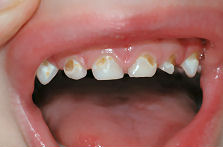 Flaschenkaries mit
                        dem Befall fast aller Milchz�hne mit Karies