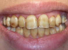Aqu todos los dientes son afectados por
                          fluorosis, por una masiva sobredosificacin de
                          flor