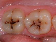 As siempre inicia la caries: En los
                          hoyitos ("fisuras") de los dientes
                          molares se quedan restos alimentarios o se
                          queda sarro, y la caries tiene la forma como
                          la de una cruz (caries del hoyito, caries
                          fisural) [16].