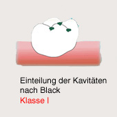 Karies-Kavit�t gem�ss Black, Klasse 1