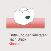 Karies-Kavit�t gem�ss Black, Klasse 2