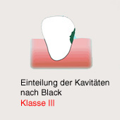 Cavidad de caries segn Black, clase 3:
                          Caries lateral al diente incisivo. [Tambin
                          aqu la caries puede "infectar" el
                          diente vecino].