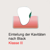 Karies-Kavit�t gem�ss Black, Klasse 3