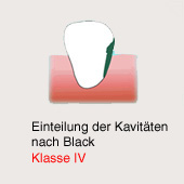 Cavidad de caries segn Black, clase 4:
                          Caries lateral al diente incisivo hasta mucho
                          al enca [peligroso para la raz del diente]