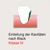 Karies-Kavit�t gem�ss Black, Klasse 4