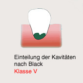 Cavidad de caries segn Black, clase 5:
                          Caries al diente incisivo en la regin la ms
                          profunda [muy peligroso para la raz del
                          diente]