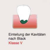 Karies-Kavit�t gem�ss Black, Klasse 5