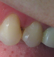 Die rotbraune Karies zwischen den
                                  Z�hnen greift zwei Z�hne gleichzeitig
                                  an. So passiert das, wenn man keine
                                  Ahnung hat und auf die Pr�vention mit
                                  Zahnseide oder Dentalhygienikerin
                                  verzichtet, hier sichtbar an einer
                                  Zahnpatientin aus Peru (2009).