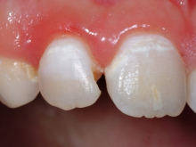Mancha blanca en un diente incisivo
                          primero (02)