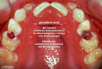 Auf
                          dem Foto sind viele weisse Flecken
                          ("Kreideflecken") zu sehen, die
                          Vorstufe von Karies, und ausserdem sind vier
                          Z�hne von Karies derart angefressen, dass
                          Teile der Z�hne bereits fehlen. Die Zahnkaries
                          hatte scheinbar leichtes Spiel, weil die
                          Person kaum die Z�hne putzt und die Wirtschaft
                          Produkte verkauft, die viel Zucker und
                          Zitronens�ure oder andere S�uren enthalten
                          (Limonaden, Birnenweggen, Getr�nke mit Zucker
                          und Ananas etc.). Die Karies ist zwischen den
                          Z�hnen entstanden und hat jeweils gleich zwei
                          Z�hne auf einmal angefressen. Mit einer
                          w�chentlichen Reinigung mit einem Dentalfaden
                          ("Zahnseide") w�re das nicht
                          passiert ... [14]
