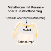 Krone: Metallkeramikkrone: Metallkrone
                          auf dem Zahnstumpf mit Keramik- oder
                          Kunststoff�berzug [29]
