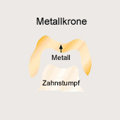 Krone: Metallkrone [29], z.B. Stahlkrone
                          zur Restauration von Milchz�hnen und zur
                          provisorischen Versorgung von bleibenden
                          Z�hnen bei Kindern [34]