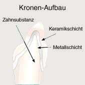 Krone
                        f�r den Schneidezahn, der Kronen-Aufbau