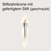 Stiftzahnkrone
                          ("Stiftzahn", Stiftkrone,
                          Richmond-Krone, Logan-Krone) f�r Schneidez�hne
                          mit geschraubtem Stift