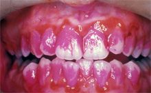 "Angef�rbte" Plaque, mit einer
                        Farbtablette sichtbar gemacht