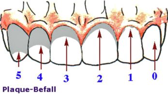 Sarro (placa bacteriana), esquema: Los
                          dentistas seccionan la placa bacteriana en
                          diversos grados, depende de la infestacin del
                          diente entre 0 (no.0) y 2/3 placa (no.5)
                          [15].