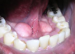 Sarro amarillo
                        (placa bacteriana), aqu sobre todo en los
                        intersecciones dentales, pero se puede verlo
                        tambin en los surcos de los dientes [43]