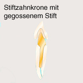 Stiftzahnkrone ("Stiftzahn",
                        Stiftkrone, Richmond-Krone, Logan-Krone) f�r
                        Schneidez�hne mit gegossenem Stift [34]