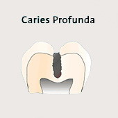 Tiefe Karies (caries profunda), Schema,
                          die Karies ist nahe am Zahnmark, das sich in
                          der Zahnmarkhhle befindet (allgemein als
                          "Nerv" bezeichnet), und die
                          Behandlung (das Ausbohren der tiefen
                          Kariesstelle) ist mit Schmerzen verbunden,
                          eventuell ist das Zahnmark ("Nerv")
                          auch schon mit Karies infiziert [4]