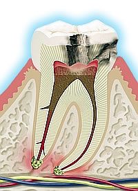 Caries de la raz
                        del diente (imagen) con nervio inflamado y
                        formacin de gases debajo de la raz del diente
                        [41]