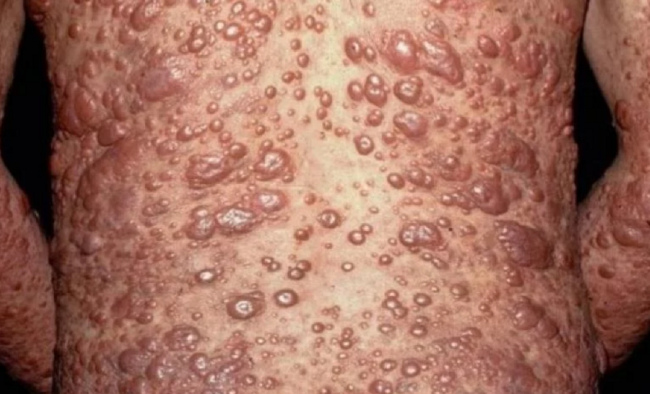 Lepra am Rücken Lepra am Rücken