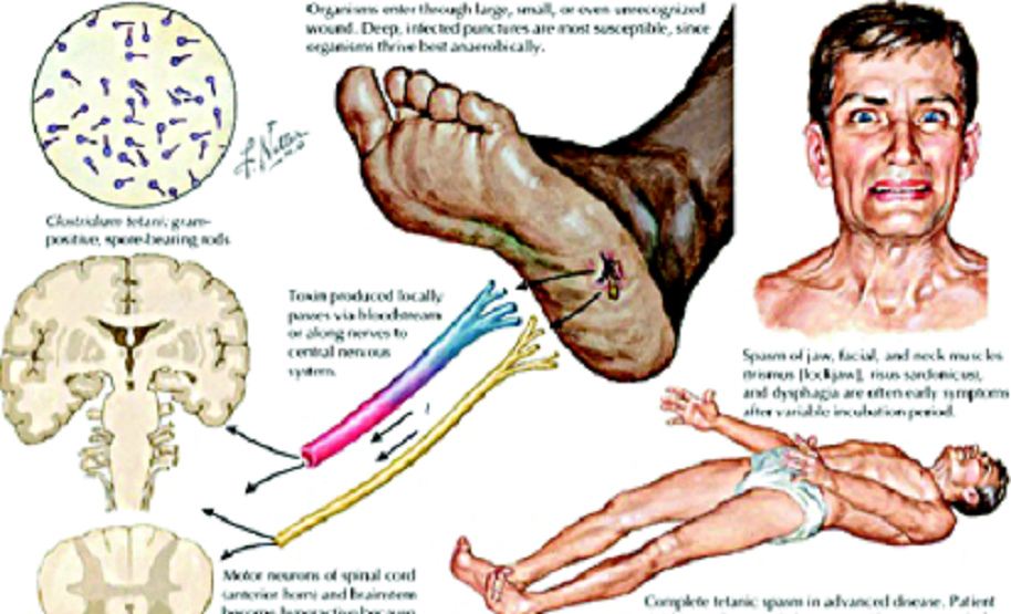 Kreislauf bei Tetanus, Schema (englisch) Kreislauf bei Tetanus, Schema (englisch)