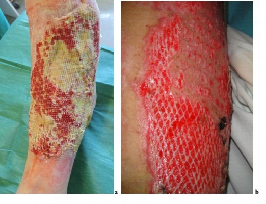 Hauttransplantation am Unterschenkel Hauttransplantation am Unterschenkel