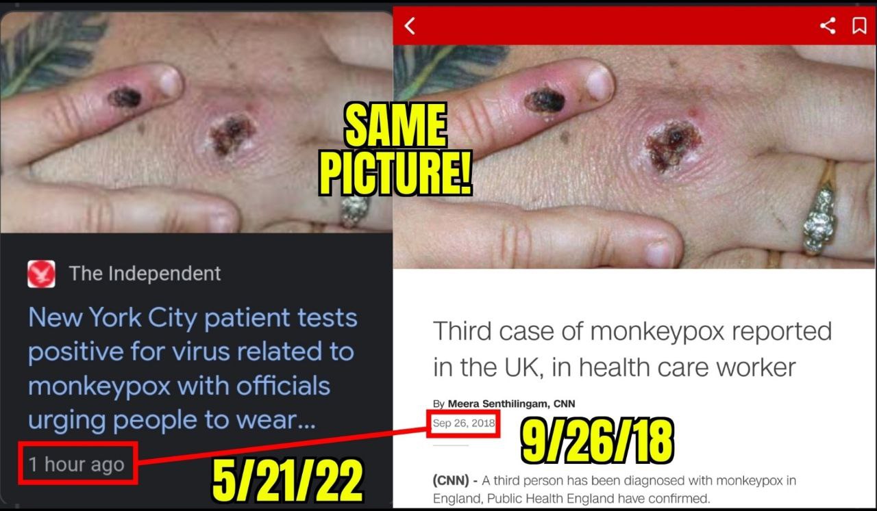 Kriminelle Rothschild-Medien 22.5.2022:
präsentieren alte Fotos von Affenpocken als
Affenpocken von 2022 04 Kriminelle
Rothschild-Medien 22.5.2022: präsentieren alte Fotos
von Affenpocken als Affenpocken von 2022 04