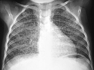 TB-Lunge mit Kntchen, Rntgenfoto