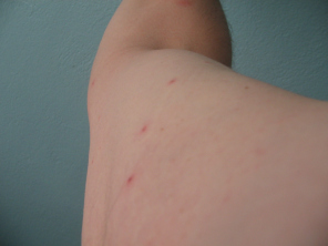 Fl�he, Frassbild 01 (2008) am
                      rechten Oberarm