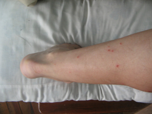 Fl�he,
                      Frassbild 03 (2008) an der linken Wade