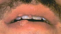 Des verrues de condylomes sur la bouche