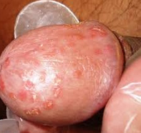 Herpes genital en el pene en el glande