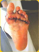 Ein vern�hter Fuss nach einer
                            Hallux-Fussoperation. Es ist nicht gesagt,
                            dass die Operation erfolgreich ist...