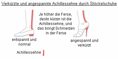 Die
                          Achillessehne verk�rzt sich beim Tragen von
                          St�ckelschuhen und ist dauernd in einem
                          angespannten Zustand