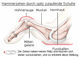 Hammerzehe, Schema: Die Zehen haben bei
                          spitz zulaufenden Schuhen keinen Platz und
                          m�ssen sich immer zur�ckziehen, und so
                          entsteht diese Kr�ppelstellung, die
                          Hammerzehe.